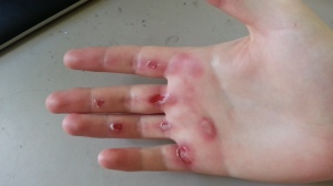 M3 bow man's hands after day 3. Ouch. Picture from Alan Rusnak.